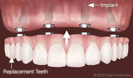 Illustration showing All on 4 implant placement and prosthetic teeth