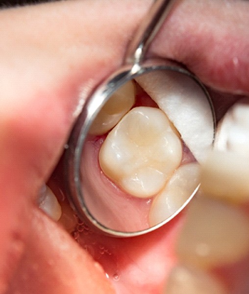Close-up of patient’s tooth-colored filling shown in dental mirror