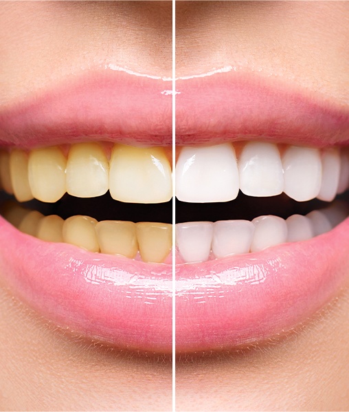 Smile before and after teeth whitening