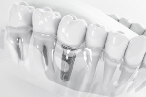 a digital image of a dental implant