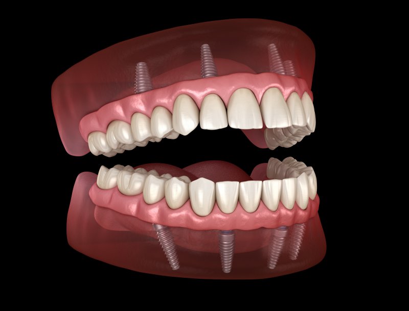 Illustration of all-on-4 dentures