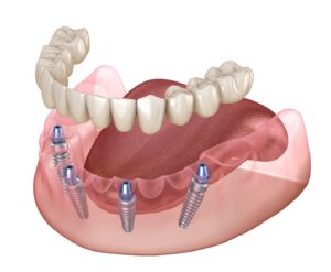 Digital rendering of All-on-4 dental implants.